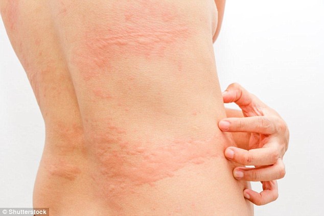 Urticaria (or hives) is a fiercely itchy skin rash. It affects at least 1 per cent of the population at any time and can be very difficult to live with, often interfering with sleep