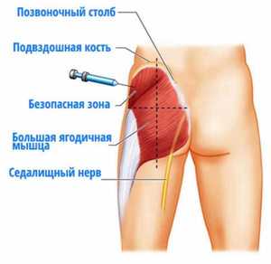 Как колоть в ягодицу