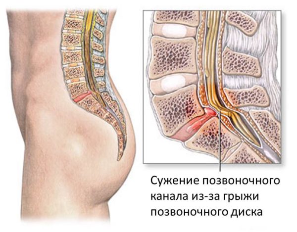 Стеноз позвоночного канала - это сужение поясничного или шейного отдела позвоночного канала